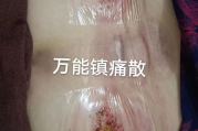 万能镇痛散配方加股骨头坏死 6.8米