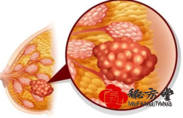 乳腺增生乳腺纤维瘤套装12.8元第2张-秘方堂