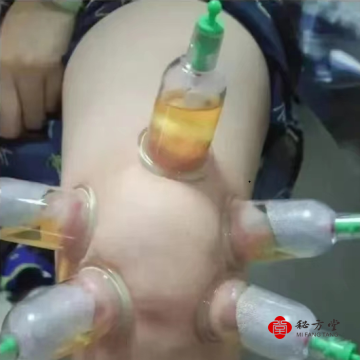 拔罐出毒药配方根治型排湿寒去痛秘法12.8元第5张-秘方堂