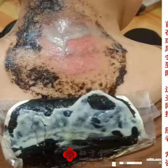 道家千年秘方提脓拔毒膏药各种疼痛克星 18元第2张-秘方堂