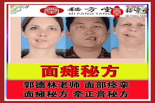 郭德林【面瘫特效全套配方转让】8.8元第1张-秘方堂